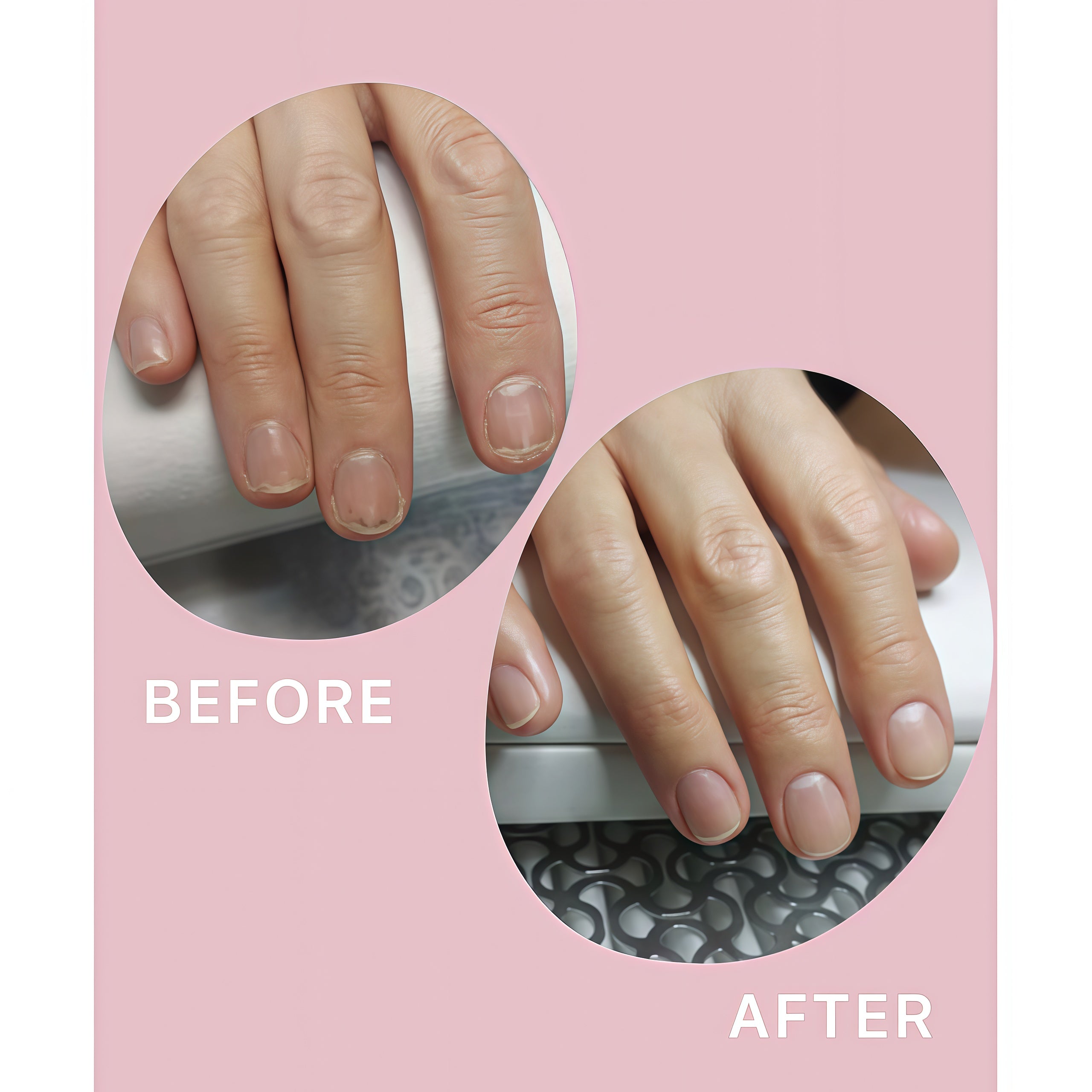 Shelly Restorative Nail Oil for Weakened & Delamination-Prone Nails with Farnesol & Tea Tree - 30 ml | Stop Onycholysis Nail Recovery Oil